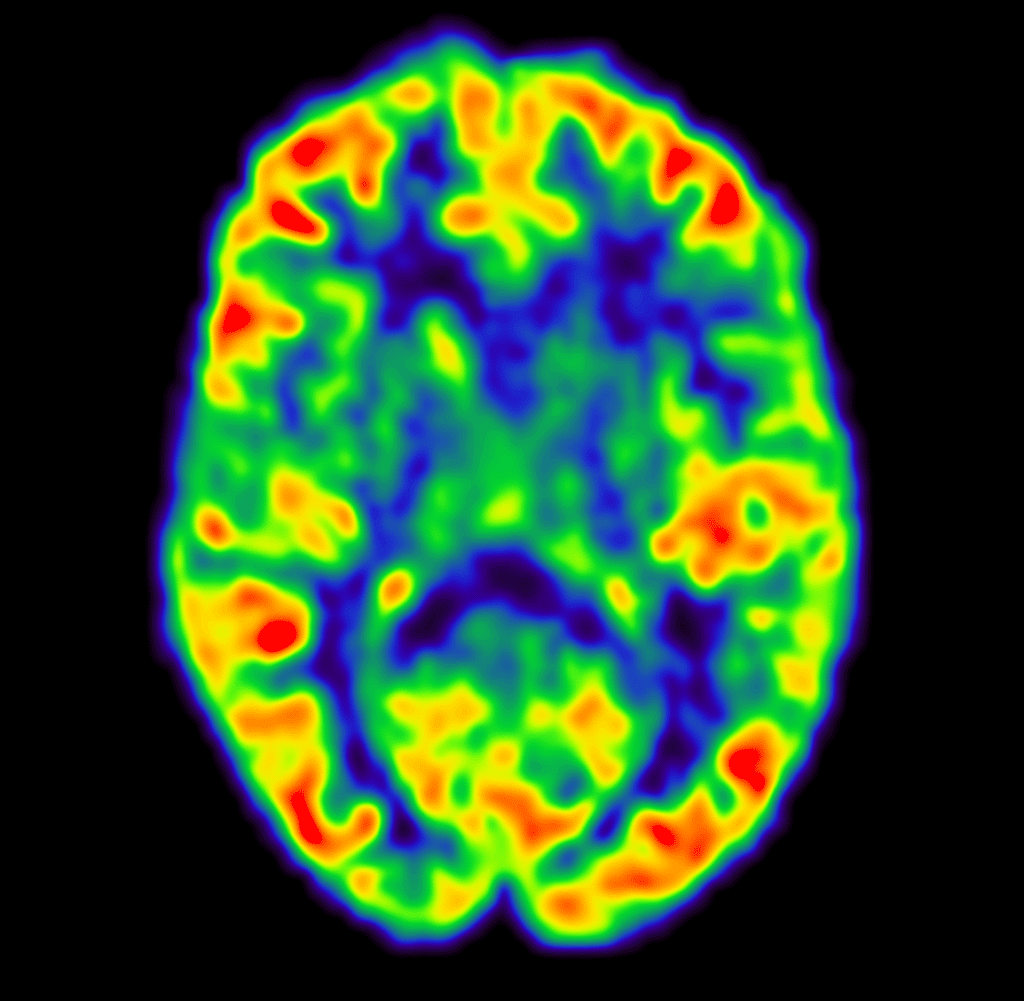 Brain scan